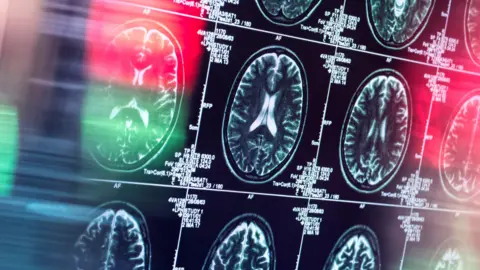 Getty Images A human brain being scanned in a neurology clinic