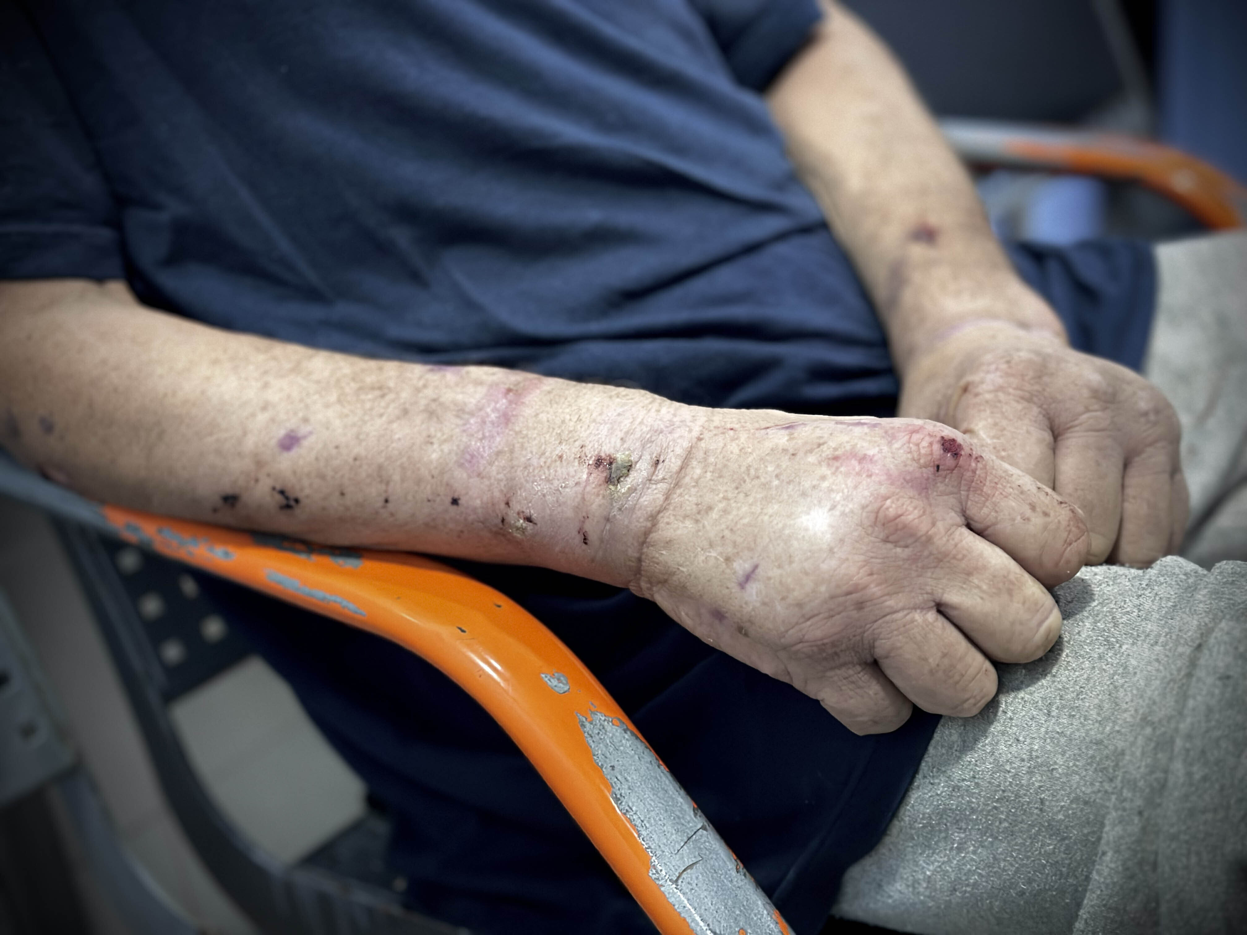 Nearly two dozen Palestinian prisoners detained by the Israeli army are taken to Nasser Hospital for medical treatment after being released at the Karm Abu Salem border crossing in Khan Younis, Gaza on Aug. 20.