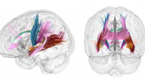  Daniela Cossio Major tracts of white matter in the brain show evidence of increasing during pregnancy