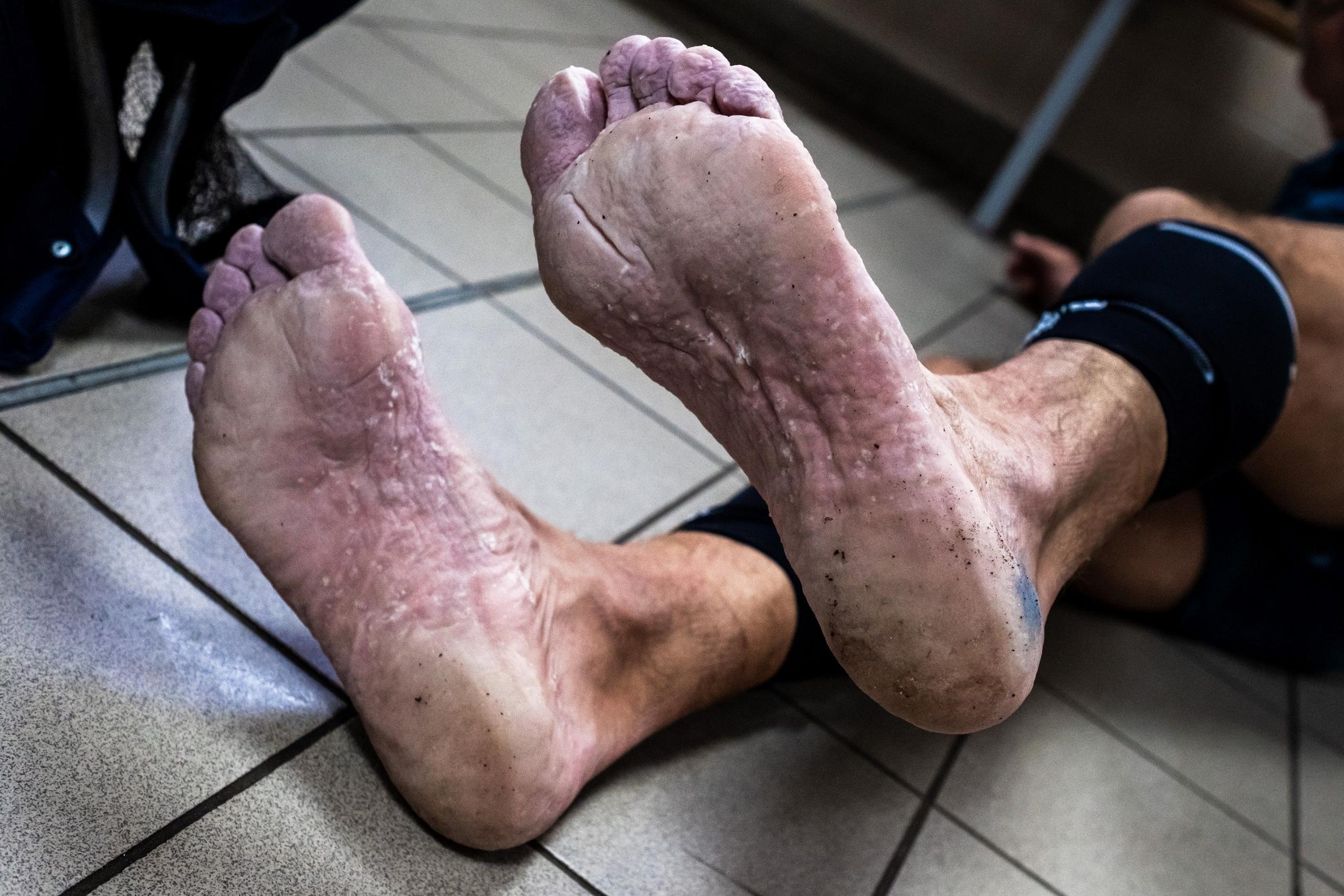 A runner's feet - with suspected trenchfoot - during the Sri Chinmoy 24hr Track Race in Battersea