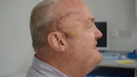 University College London Hospitals NHS Foundation Trust Side profile of Paul looking to the right. His scar from brain tumour surgery can we seen clearly and is thin dark purple line in an almost crescent shape. It begins just above his right eyebrow, travels back to his hair, curving down to reach his ear. The scar stops just in front of the middle of Paul's ear. His background is blurred but looks to be a medical setting with plain white walls and a computer. 