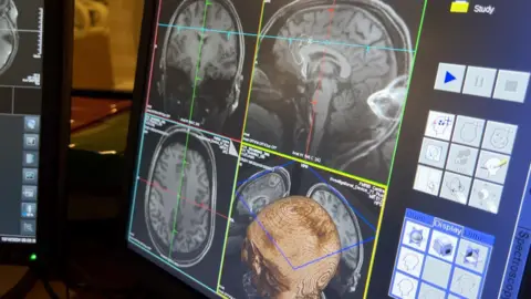 MRI brain scan images on a computer