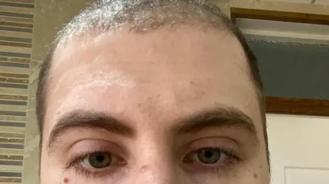 Submitted by user Close up photo of Kyle, shortly after starting on finasteride